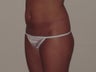 Mini abdominoplasty