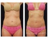 Abdominoplasty - Tummy Tuck