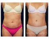 Abdominoplasty - Tummy Tuck