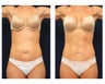 Abdominoplasty - Tummy Tuck