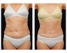 Abdominoplasty - Tummy Tuck