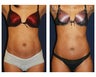 Abdominoplasty - Tummy Tuck