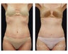 Abdominoplasty - Tummy Tuck