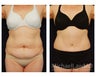 Abdominoplasty - Tummy Tuck