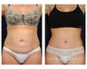 Abdominoplasty - Tummy Tuck