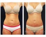 Abdominoplasty - Tummy Tuck