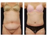Abdominoplasty - Tummy Tuck