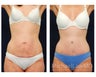 Abdominoplasty - Tummy Tuck