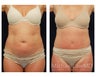 Abdominoplasty - Tummy Tuck