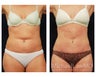 Abdominoplasty - Tummy Tuck