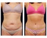 Abdominoplasty - Tummy Tuck