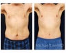 Abdominoplasty - Tummy Tuck
