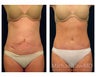 Abdominoplasty - Tummy Tuck