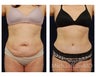 Abdominoplasty - Tummy Tuck