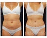 Abdominoplasty - Tummy Tuck