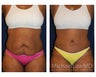 Abdominoplasty - Tummy Tuck
