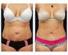 Abdominoplasty - Tummy Tuck