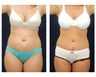 Abdominoplasty - Tummy Tuck