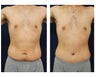 Abdominoplasty - Tummy Tuck