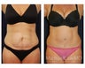 Abdominoplasty - Tummy Tuck
