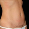 Mini Tummy Tuck