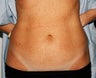 Mini-abdominoplasty