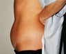 Mini-abdominoplasty