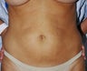 Mini-abdominoplasty