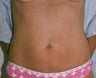 Mini-abdominoplasty