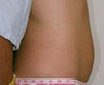 Mini-abdominoplasty