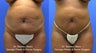 Mini Tummy Tuck