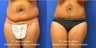 Mini Tummy Tuck