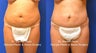 Mini Tummy Tuck
