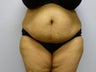 Mini Tummy Tuck and liposuction