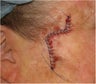 Closure of Mohs Surgery Defect