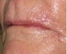 Closure of Mohs surgery defect