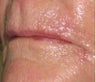 Upper lip flap closure after Mohs Surgery