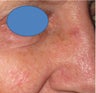 Mohs surgery defect repair