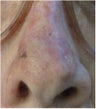 Mohs surgery defect of dorsum of the nose