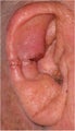 Right ear Mohs defect and repair