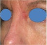 Repair of Mohs surgery defect on the left nose