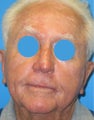 Moh's surgery nasal reconstruction