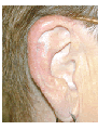 Skin cancer reconstruction on ear
