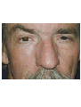 Sskin cancer reconstruction on the cheek