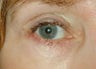 Eyelid skin cancer reconstruction