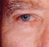 Eyelid skin cancer reconstruction