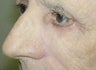 Eyelid and cheek skin cancer reconstruction