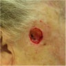 Closure of Mohs Surgery Defect