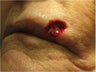 Closure of Mohs surgery defect