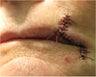 Upper lip flap closure after Mohs Surgery